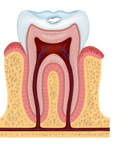 tooth decay stages - white spots - colgate my