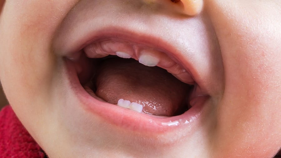 ulcer mulut pada kanak - colgate my