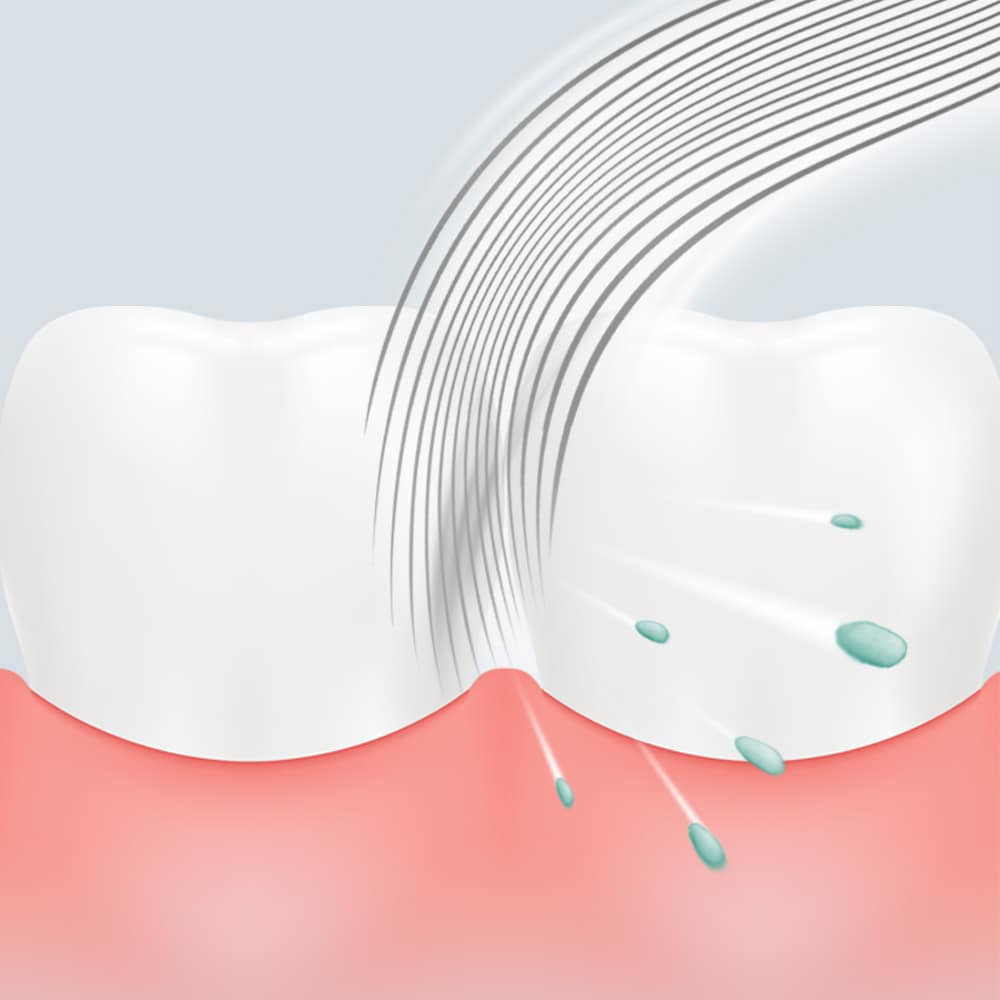 Partikel makanan dikeluarkan dari celah gigi